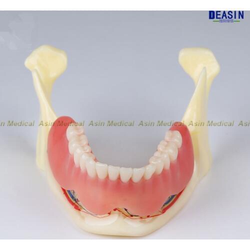 Dental High Quality Resin Mandibular Fenture Coverage Model Mandible Belt Nerve Model Display Dentures Removable Teeth Model