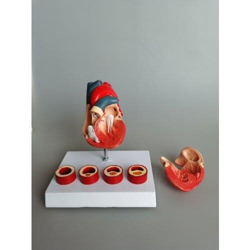 Anatomical model of heart and thrombus