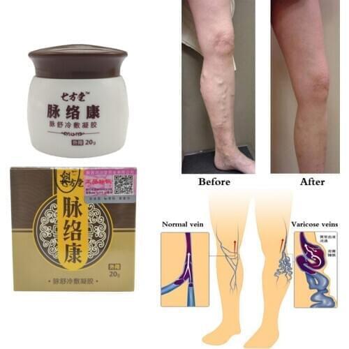 100% Original Medicine PlasterTreatment Spider Veins Varicose Gel Varicose Veins Vasculitis Health Care Cream Ointment