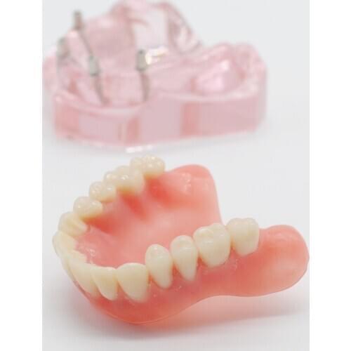 Dental Teeth Model Overdenture Upper Anterior Maxillary 4 Implants Restoration Dentist Item Dentures Tooth Extraction