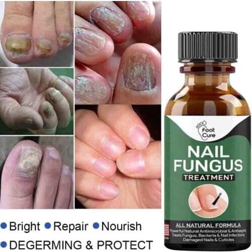 Fungal Nail Treatment Serum Nail Finger Toe Repair Anti Fungal Nail Treatment Essence Onychomycosis Removal Essence Foot Care