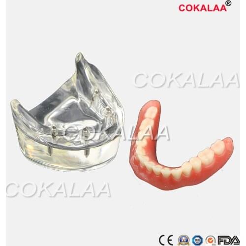 Free shipping Special Offer Dental Teeth Study Model Overdenture Inferior Implant Demo Model