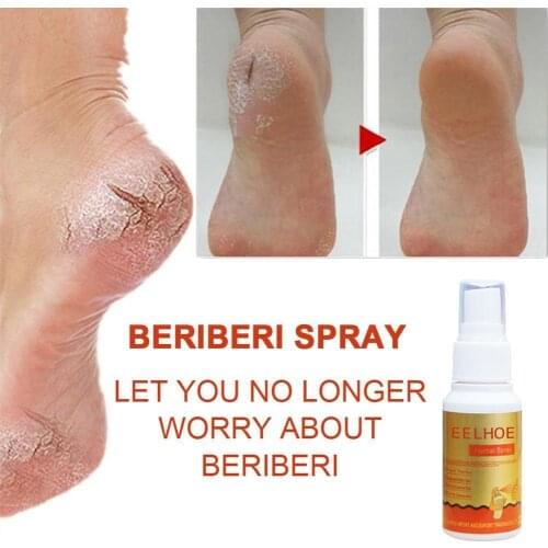 Chinese Medicine Feet Care Smelly Sweaty Useful Itching Mist Athletes Foot Cream Foot Odor Treatment Eliminator Foot Itching