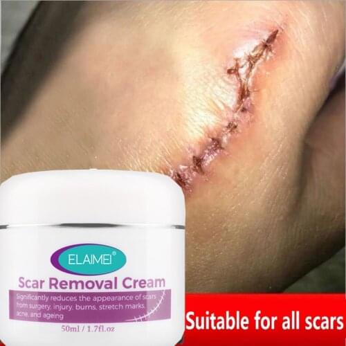 Acne Scar Removal Cream For Old Scar Caesarean Scars Surgical Scars Burn Scars Body Care Herbs Cream Kids&Adults 50g
