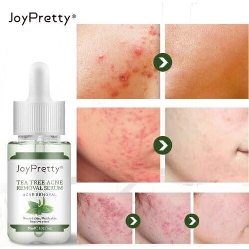 30ml Tea Tree Acne Removal Serum Acne Exfoliating Anti-Inflammation Moisturizing Essence Gently Repair Purify Skin Whitening