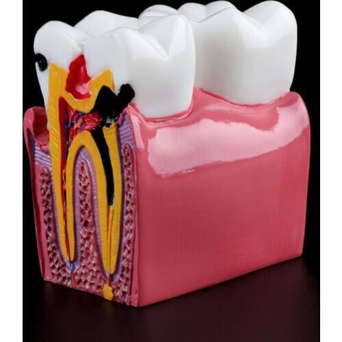 6 Times Dental Caries Comparation Anatomy Teeth Model for Dental Anatomy Lab Teaching Studying Researching Tool