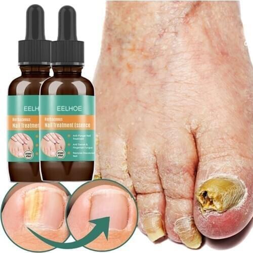 1Pc Effect Fungus Removal Essence Liquid Fungal Nail Treatment Bright Nail Repair Anti Infection Foot Caring Plasters