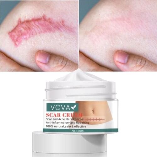 Scar Removal Cream Stretch Marks Treatment Cream Remove Acne Pimples Smoothing Whitening Moisturizing Body Skin Repair Care 30ml