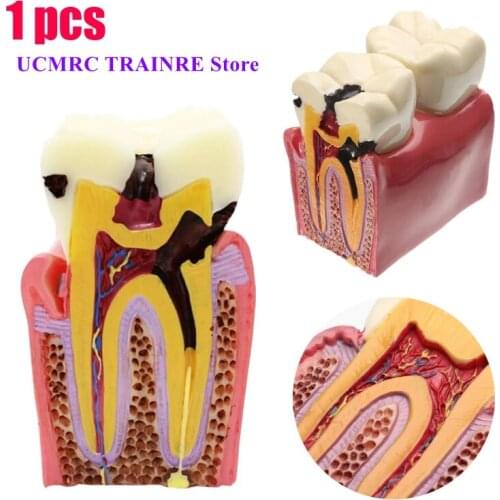 Dental Teeth Model 6 Times Caries Comparation Study Denture Tooth Models Dentist Studying and Researching Dentistry Product