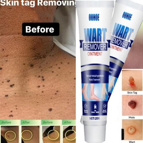 Wart Removal Cream Wart Treatment Instant Removal Mole and Papillomas Foot Corn Repair Tool Natural Bacteriostatic cream 20g
