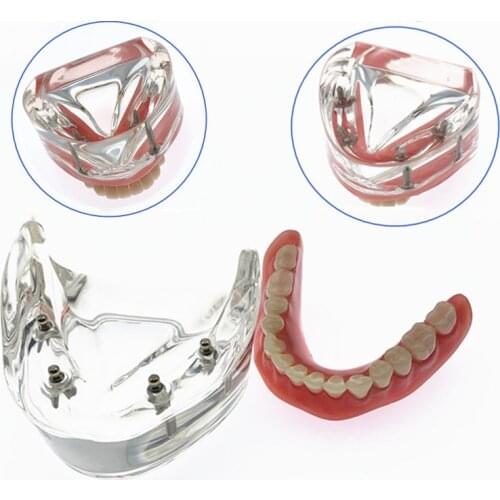 Dental Model With 4 Implant Overdenture Inferior Demo Teeth Study Model 6002