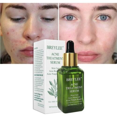Acne Treatment Face Serum Facial Acne Anti Acne Pimple Scar Remover Moisturizing Whitening Skin Care Face Care Cream 17ml TSLM1
