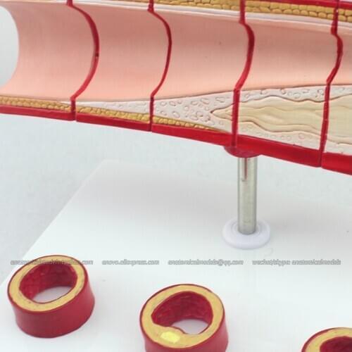 CMAM/12484 Heart-Vascular cholesterol, Human Heart Medical Teaching Anatomical Model