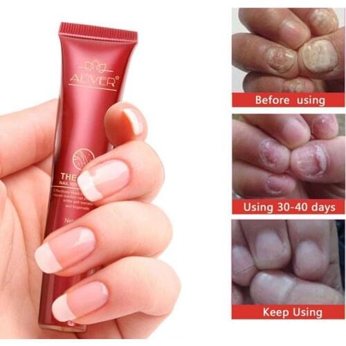 Nail Protector Skin Care Cream Onychomycosis Nail Fungus Care Tools Nails Cream Repair Nail Treatment Herb X8U3