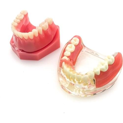 Dental Implant Restoration Teeth Model Removable Bridge Denture Teaching research model