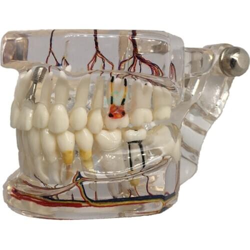New Dental Teaching Teeth Model Implant with Nerve Transparent Pathological Repair Teaching demonstration model