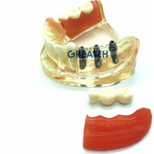 Dental Demonstration Model Teeth for Implant Restoration Teeth Model Removable Bridge dentist studying patience model