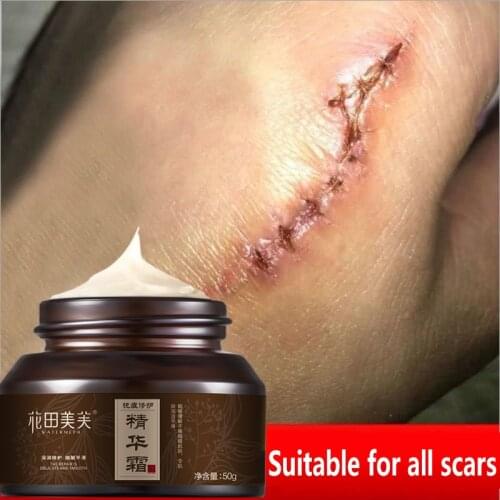 Acne scar removal cream For Old scar Caesarean scars surgical scars burn scars body care Herbs cream kids&Adults 50g