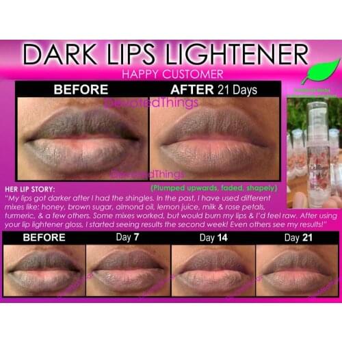 7+ Before and After Best Lip Lightening Bleach Bleaching Brightening Naturally