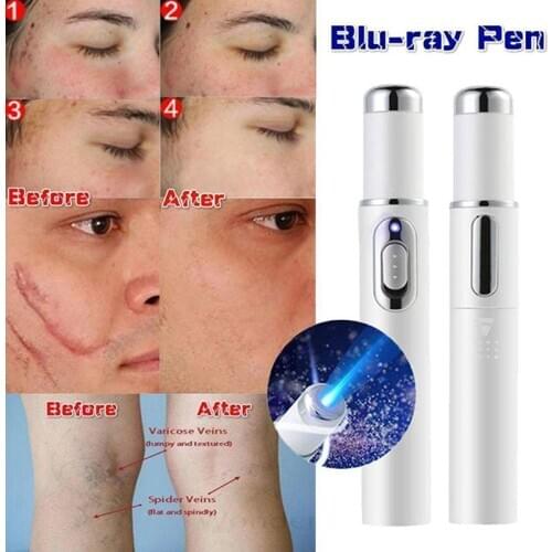 HNKMP Cream For Varicose Veins