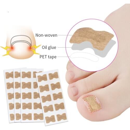 Ingrown Toenail Corrector Stickers Paronychia Treatment Pedicure Toe Nail Care Corrector Patch Correction Stickers 10-50Pcs