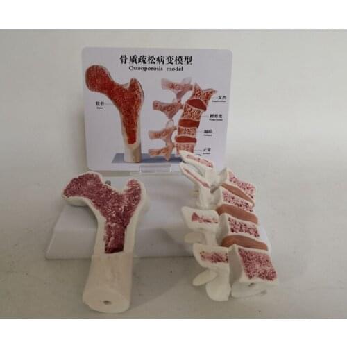 Human Osteoporosis Femoral Head Skeleton Spine Anatomical Lesion Model Free Shipping