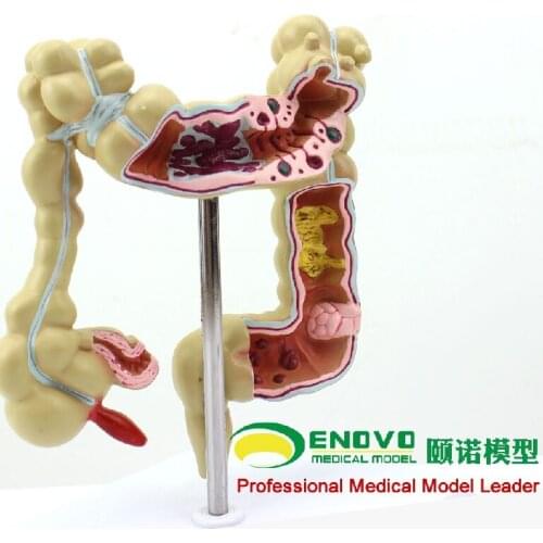 Colorectal cancer colorectal cancer colorectal cancer gastrointestinal