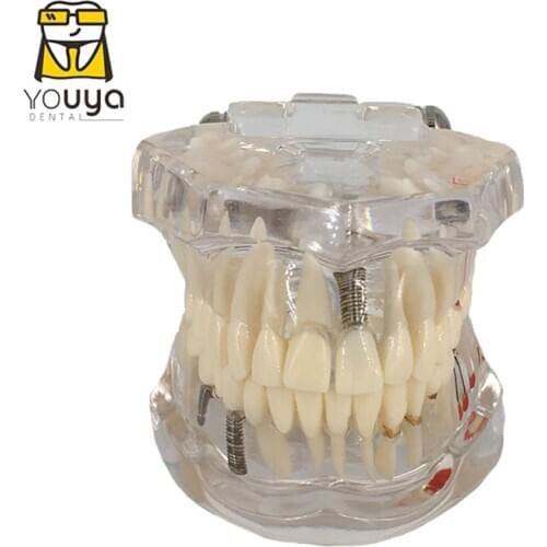 Transparent Disease Teeth Model Dental Implant Teeth Model Dentist Dental Student Learning, Teaching, Research Communication