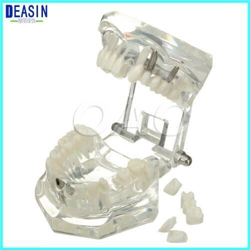 Removable Dental Implant Disease Teaching Teeth Model & Restoration Bridge Tooth