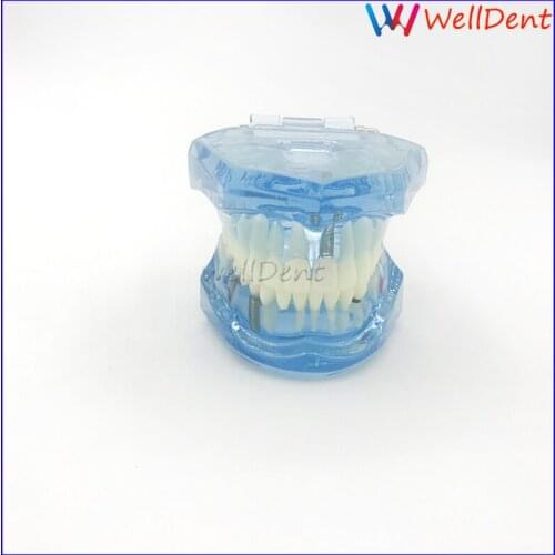 Dental Teeth Model Study Teaching Teeth Model Tooth Model Adult Pathological New Denshine Dentist Dental Materials
