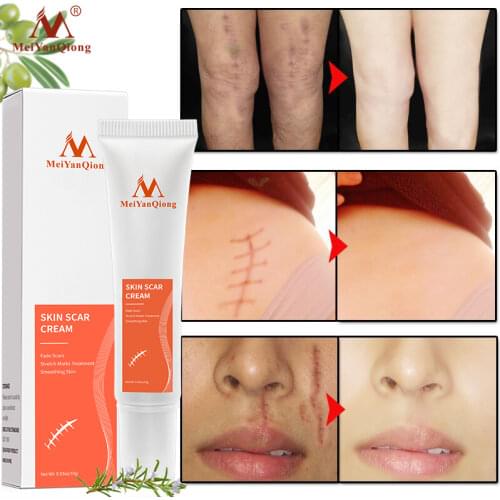 MeiYanQiong Acne Scar Removal Cream Skin Repair Face Cream Whitening Moisturizing Cream Skin Care Lighten Scars