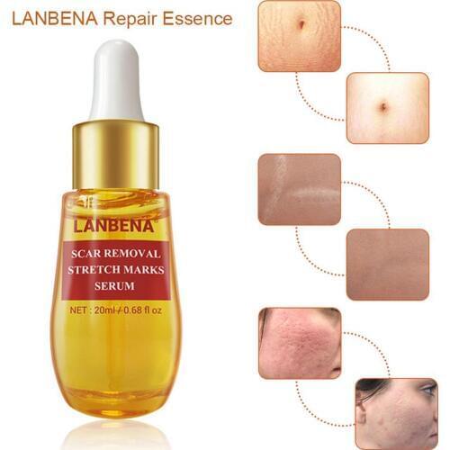 LANBENA Acne Scar Remove Serum Acne Treatment Remover Stretch Marks Anti Acne Shrink Pores Blackhead Whitening Cream Skin Care 2