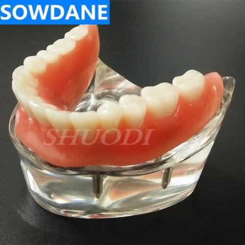 Dental Overdenture Interior Mandibular Lower with 4 Implant Restoration Teeth Study Teach Model