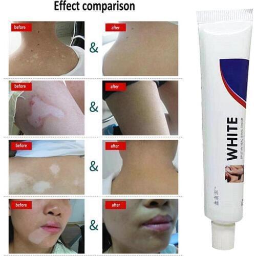 Chinese Medical White Spot Disease Cream Pigment Melanin Promoting Vitiligo Skin Treatment Leukoplakia Disease White Spot I3X7