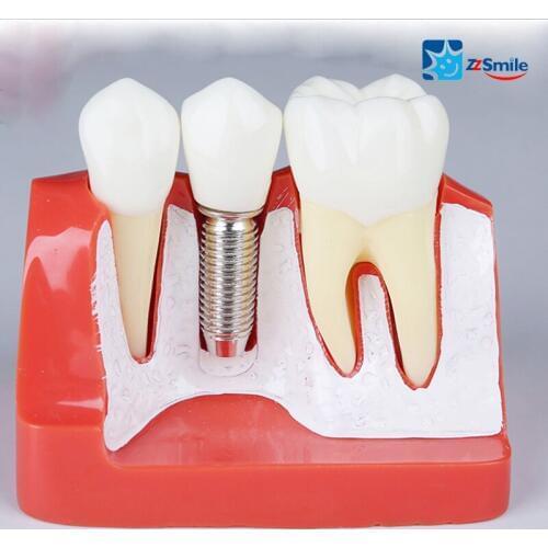 Dental Implant Model/Dental Implant Analysis Crown Bridge Demonstration Teeth Model M2017R