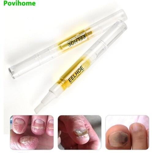 1/3pcs Anti-Fungal Powerful Nail Treatment Pen ParonychiaNail Cuticle Remover Liquid Nail Growth Chinese Herbal Toe Fungus Care