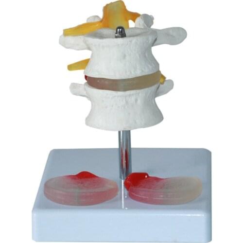 Human lumbar model Spinal pathology model Disc lesional vertebrae