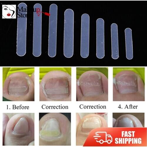 100pcs/box Ingrown Pedicure Toenail Straightening Clip Toe Nail Sticker Supporting Toenail Thick Film Patch Foot Care Tool