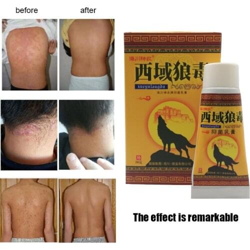 Western Wolf Venom Cream Treatment Psoriasis Erythema Itching Relife The Pain Antibacterial Chinese Herbal Medicine Skin Care