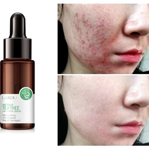 Teatree Anti Acene Face Serum Remove Pimples Fade Acne Marks Shrink Pores Hydration Skin Care Essence Facial Serum