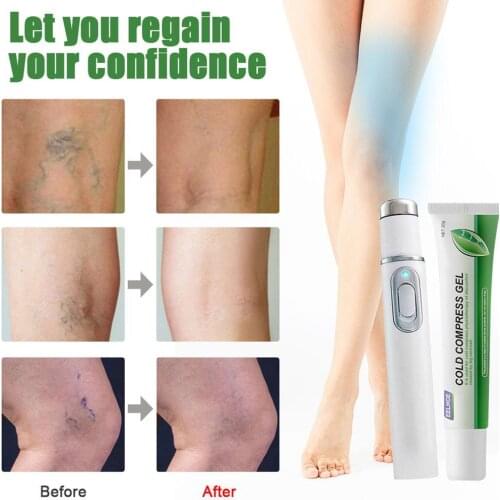 20g Varicose Vein Soothing Set Blue Light Treatment Pen +Cold Compress Gel Leg Swelling Relieve Pain Therapy Care Ointment Cream