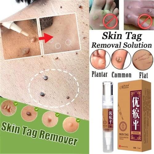 Genital Wart Treatment Papillomas Removal of Warts Liquid From Skin Tags Removing Against Moles Remover Anti Verruca Remedy 5ml