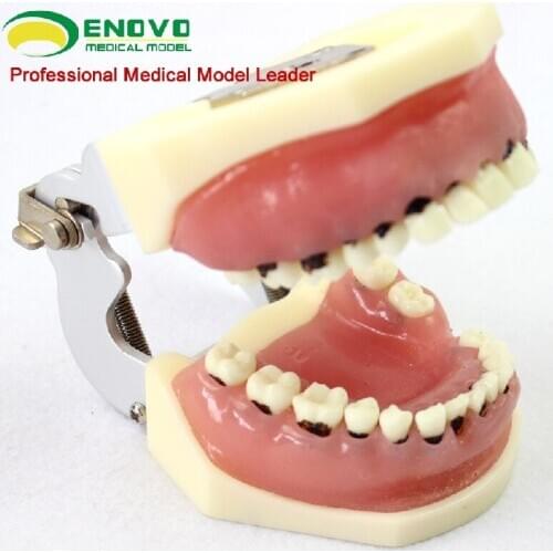 Dental Severe Dentistry Periodontal Model Dental calculus Scaling Gingival suture Model Dividing
