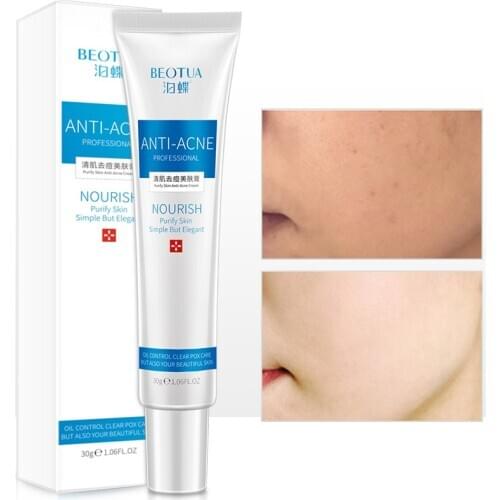 Blemish Cream Spots Removal Treatment Pimple Ointment Scar Mark Anti-acne Water-oil Cream Beauty Cream facial care 30g/PCS HOT