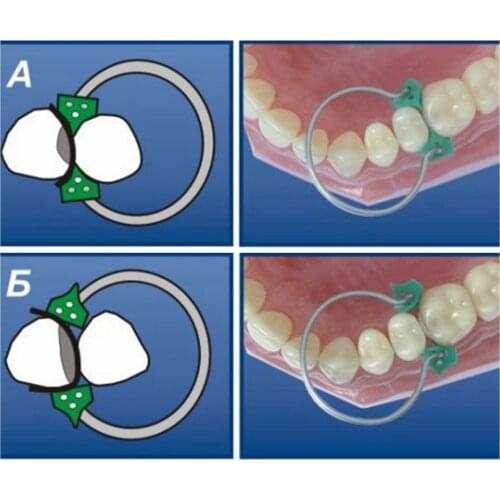 100Pcs/Set Dental Sectional Contoured Matrices Matrix Ring Delta+40Pcs Add-On Wedge