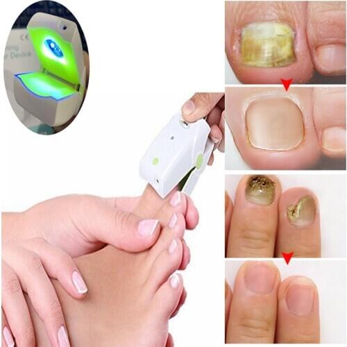 Personal Healthcare Home Use Laser Nail Fungus Light Therapy device Cure Nail Fungal Infection onychomycosis