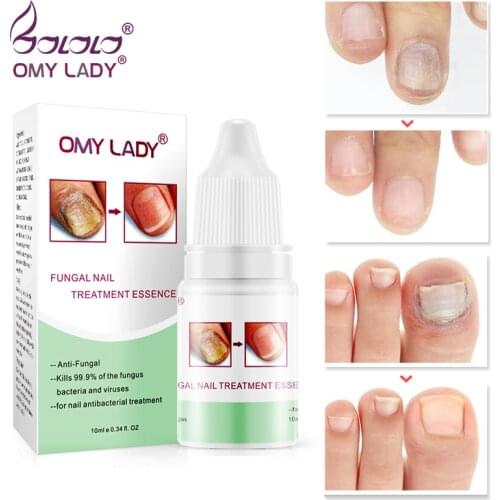 OMYLADY Nail Care Gel Fungal Nail Treatment Remove Onychomycosis Nail Care Nourishing Effective against nail Hand And Foot Care