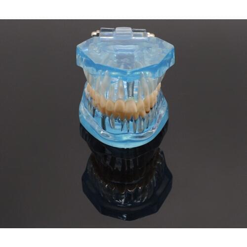 Dental Product Study Tooth Model Adult Pathological Teaching Teeth Model Caries