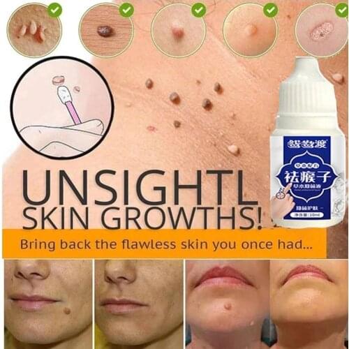 10ML Skin Tag Remover Genital Wart Treatment Instant Removal Mole&Papillomas Foot Corn Repair Tool Natural Bacteriostatic Liquid
