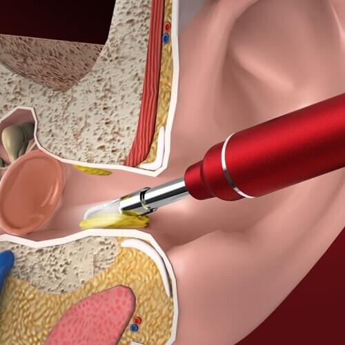 TIMESISO P40 3.9mm Ear Cleaning Tool HD Visual Ear Spoon Multifunctional Earpick with Mini Camera with 6pcs LED lights